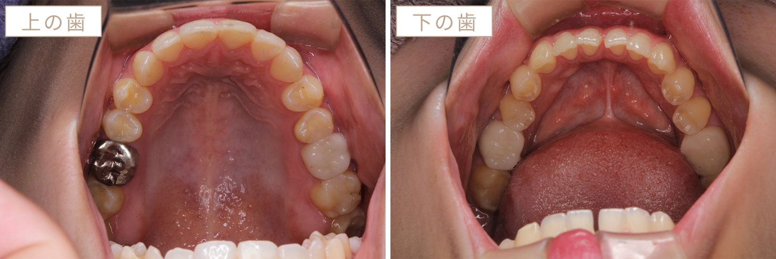 上の歯のみ 口ゴボの症例写真・治療前