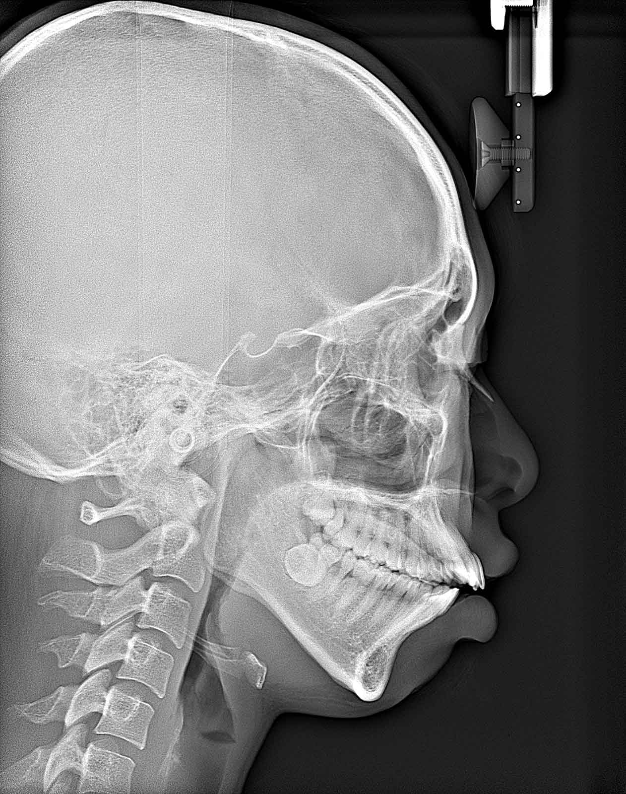 オープンバイトの症例写真・治療前