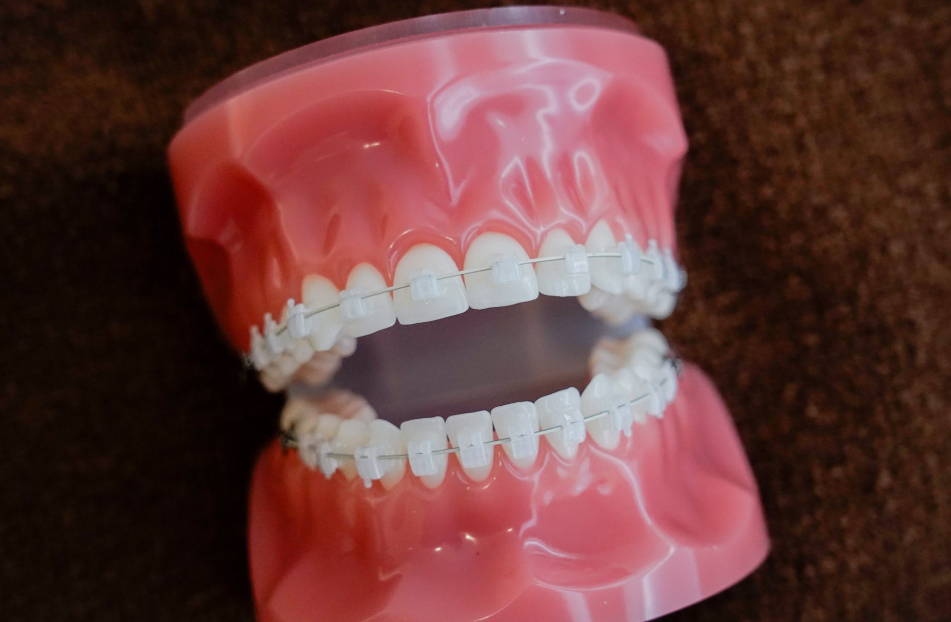 歯列矯正に対する誤解