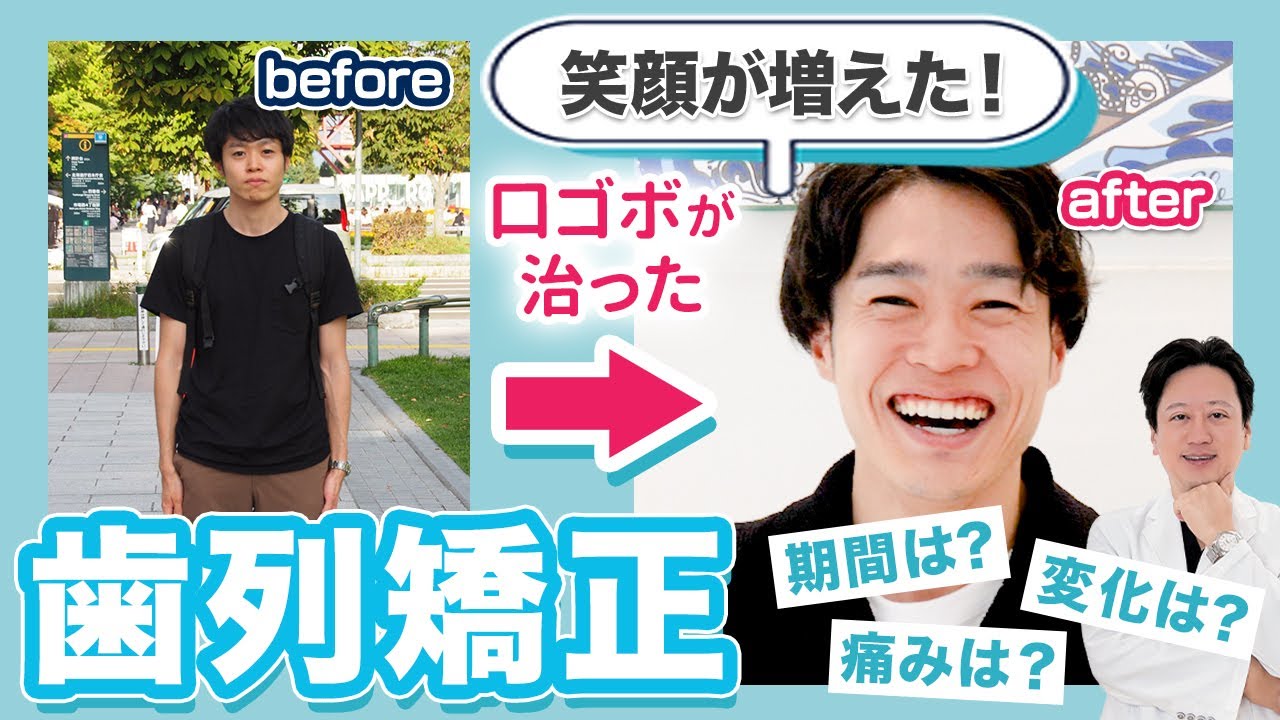 Eライン改善！費用・痛み・変化など歯列矯正で感じた全てを話します【審美歯科 歯列矯正 歯並び 口ゴボ】