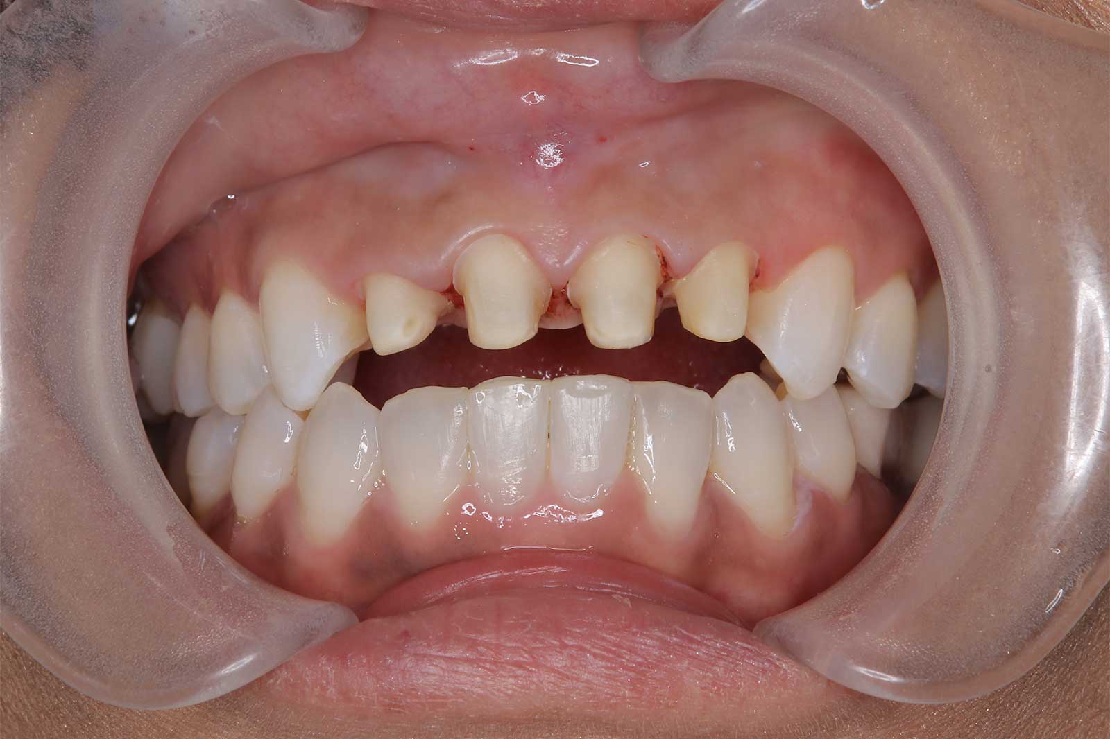 セラミック矯正は「自分の歯を削る」というリスクが伴う