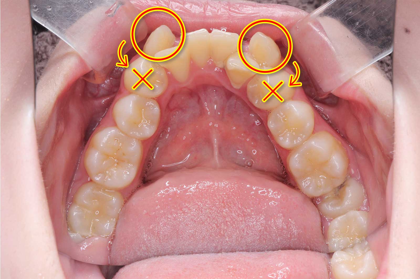 八重歯の歯列矯正