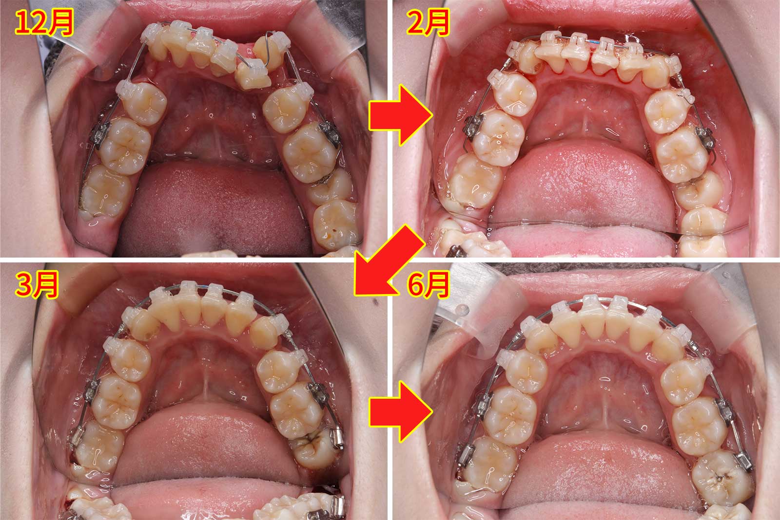 八重歯の歯列矯正の症例
