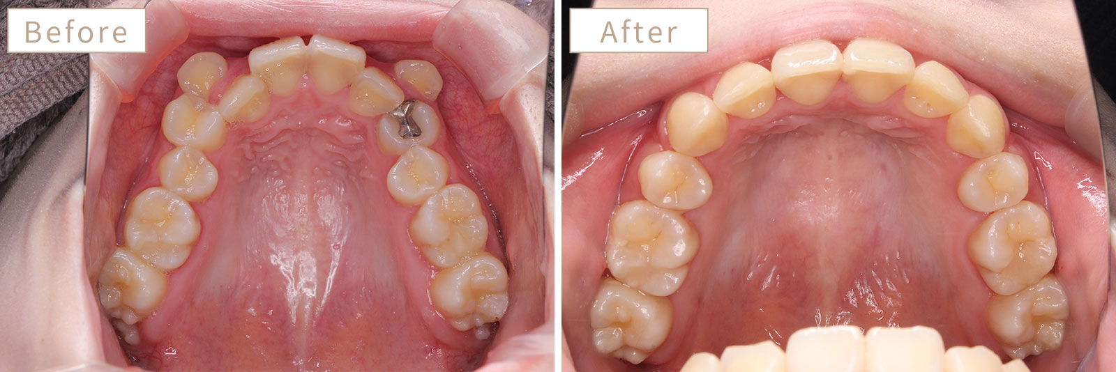 八重歯の歯列矯正の症例