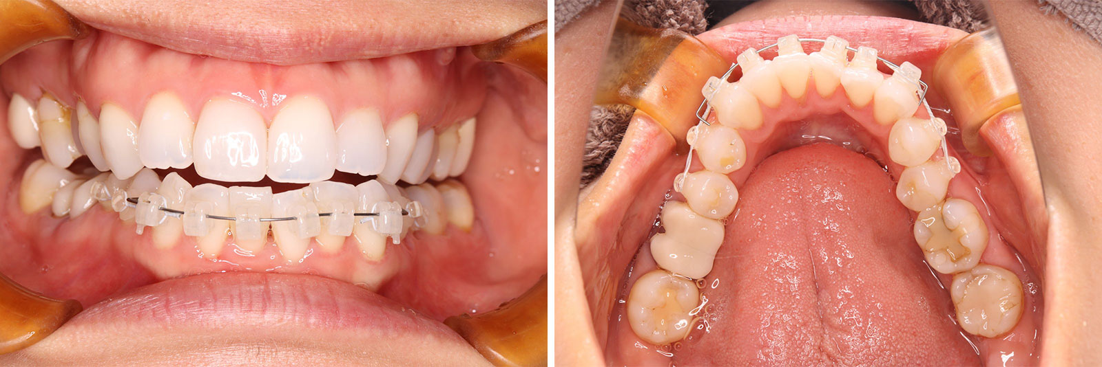 部分矯正の症例ビフォーアフター