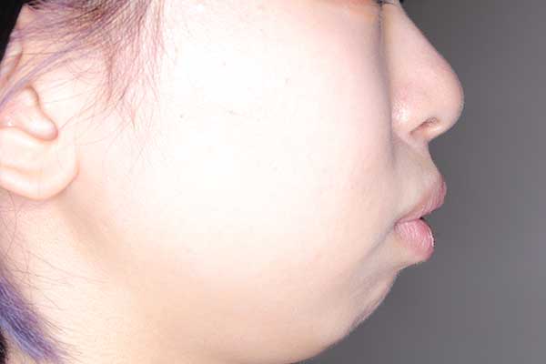口ゴボを治す矯正の症例写真・治療前