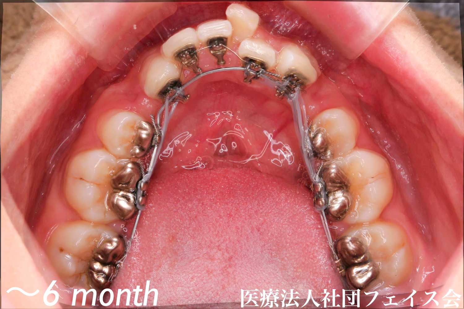 裏側矯正 006 | アニバーサリーデンタルギンザ