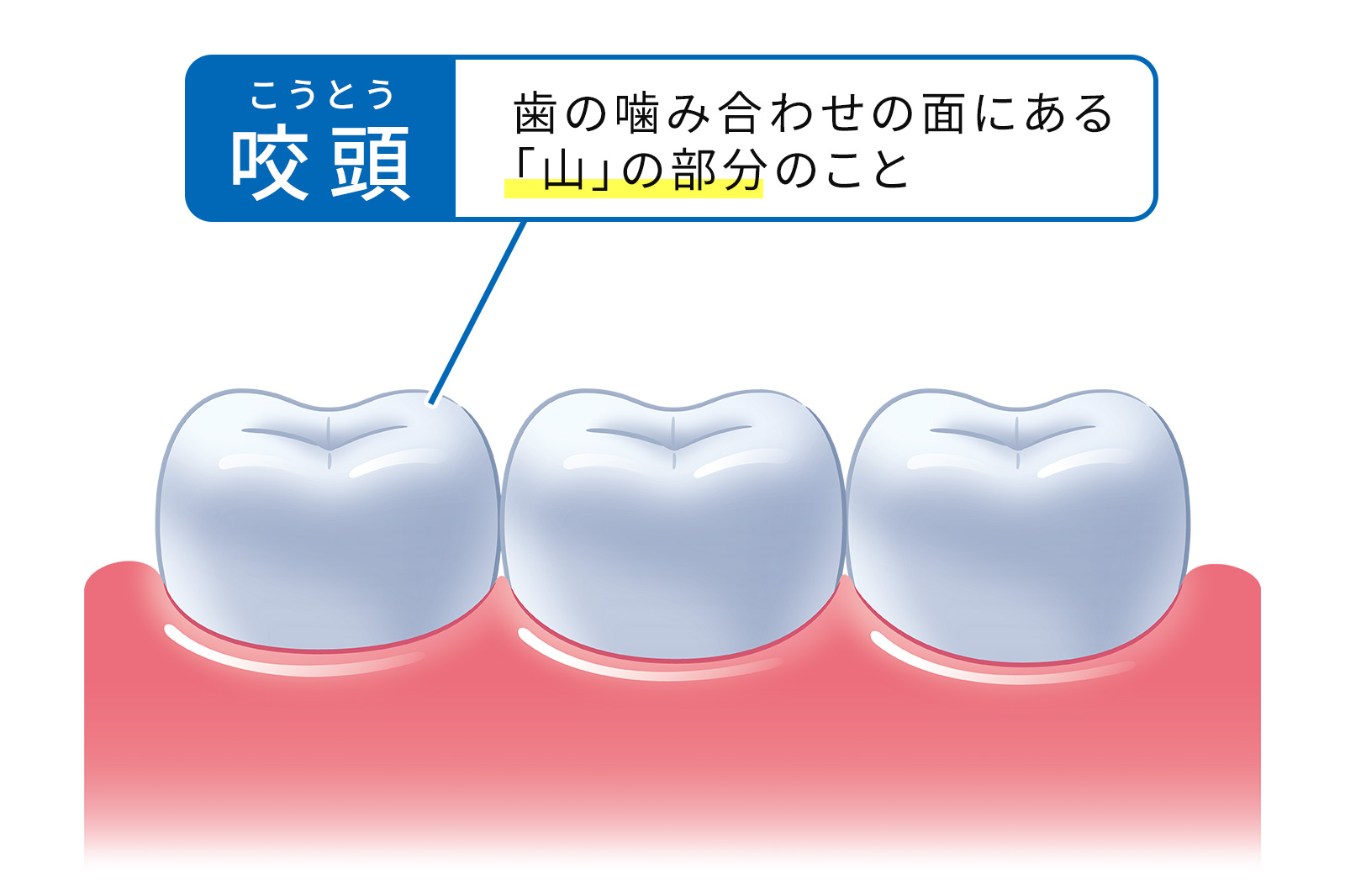 適している詰め物を見極めるポイント「咬頭（こうとう）」