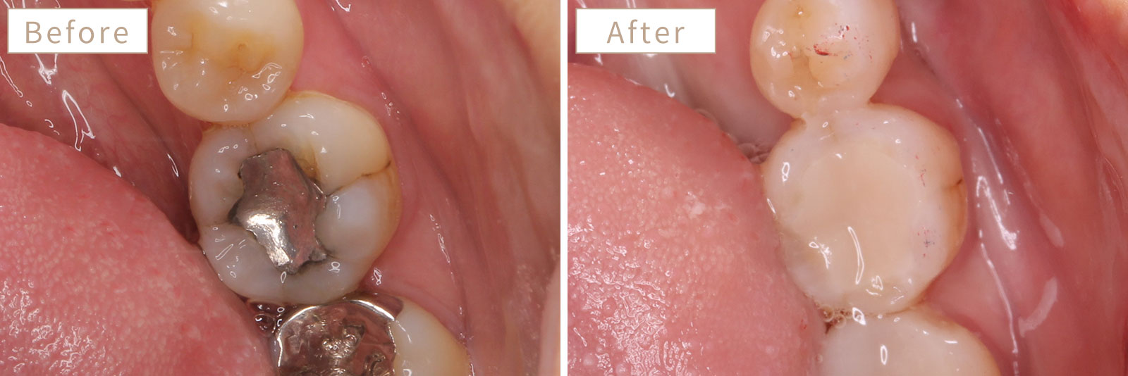 銀歯をセラミックなど白い詰め物に変えた症例