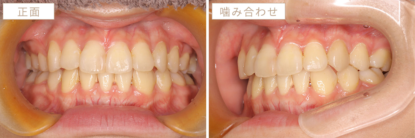 ガチャ歯の歯列矯正の症例